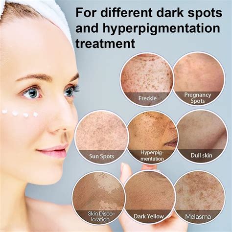 Dark Spot Remover for Face | Hyperpigmentation & Melasma Treatment ...