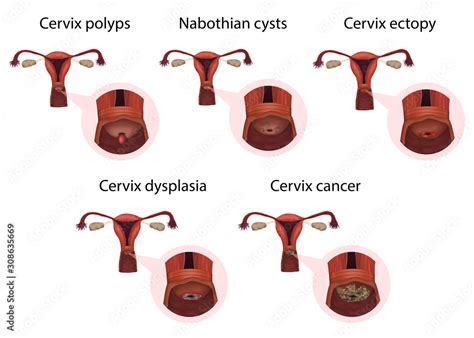 Cervical diseases. Cervix polyps, ectopy, dysplasia, cancer, nabothian ...