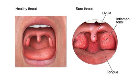 Sore Throat: Causes and Treatment - Pediatrics Northwest