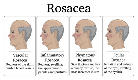 Dealing With Rosacea - Charleston Dermatology