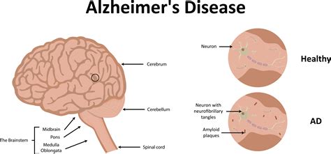 Role of Tau in Neurodegenerative Diseases - RE:mind