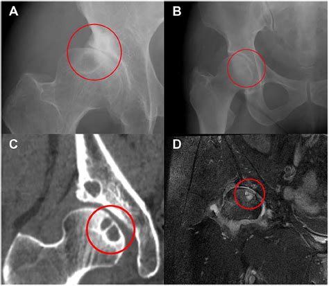 Subchondral Cyst