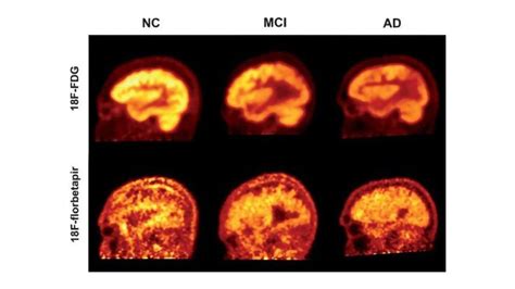 Amyloid PET Scans Say Little About Cognitive Function | Technology Networks