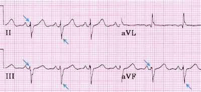 Study Medical Photos: Left Anterior Fascicular Block - ECG