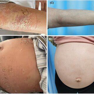 Generalized pustular psoriasis (GPP) of pregnancy before and after ...