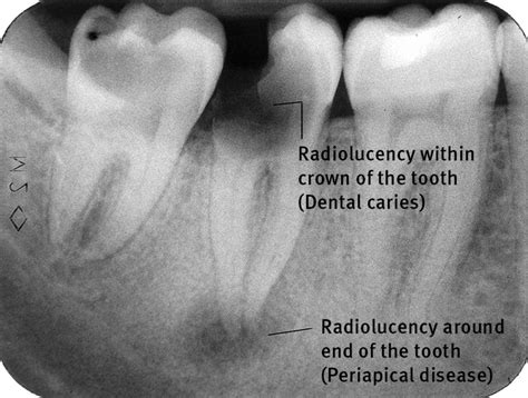 Management of severe acute dental infections | The BMJ