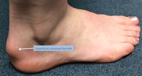 What Is Superficial Calcaneal Bursitis? | LFAC