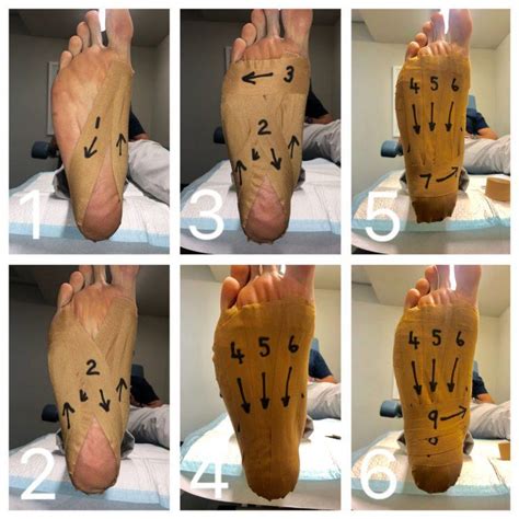 Useful Strapping technique for plantar fasciitis/heel pain ...