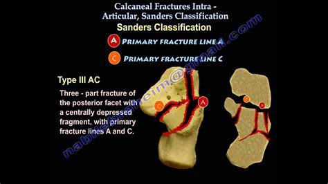 Calcaneus Fracture Classification