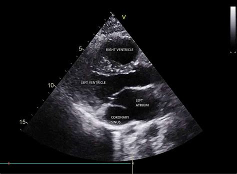 A Rare Case of an Unroofed Coronary Sinus With a Persistent Left ...