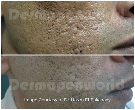 What is Cystic Acne? - DermapenWorld