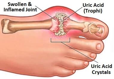 Foot Gout & Podagra: Treatment & Prevention - Foot Pain Explored