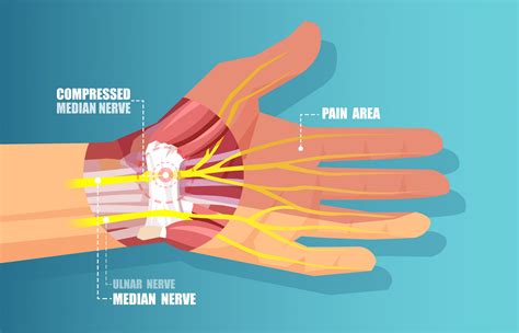 How do you get a Wrist Ligament Tear? | USA Spine Care & Orthopedics