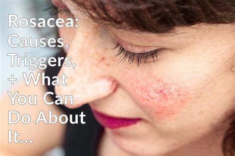 Rosacea - Causes, Triggers & What You Can Do About It