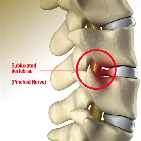 Pinched Nerve Treatment | Monmouth Pain