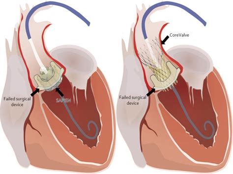 Valve-in-Valve TAVR Success May Depend on Surgical Factors