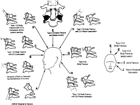 Cervical Spine Fracture Classification