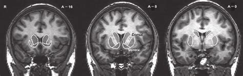 3 Ventral and dorsal striatum . (as specified by Mawlawi et al. , 2001 ...