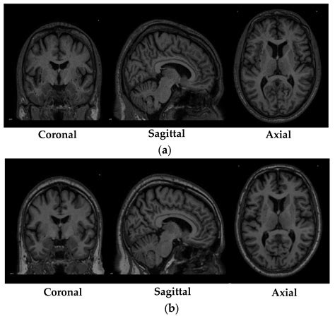 3d brain mri classification