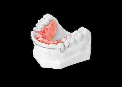 Standard Hawley Retainer (Upper) - Universal Orthodontic Lab