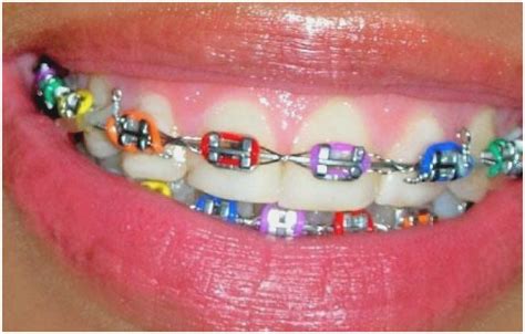 Colored Braces and Bands — Murray Orthodontics