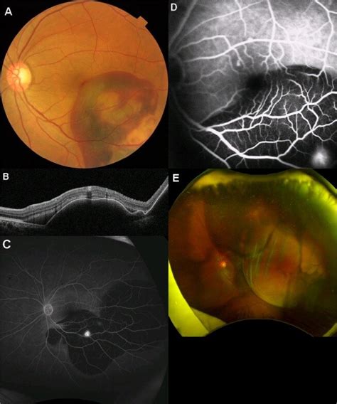 Eye Hemorrhage Anatomy