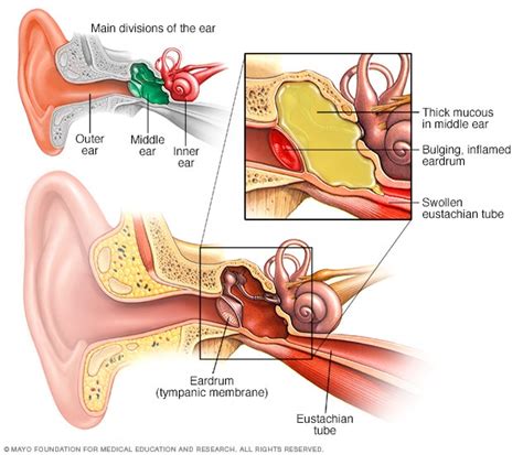 Ear infection (middle ear) - Symptoms and causes - Mayo Clinic