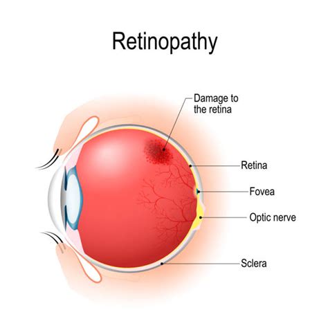 Eye Hemorrhage Stock Photos, Pictures & Royalty-Free Images - iStock