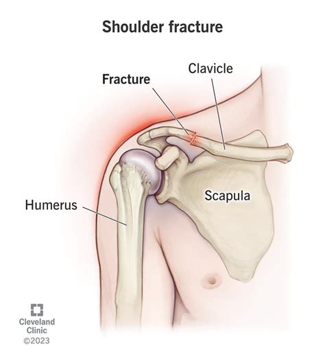 Shoulder Fracture: Symptoms, Treatment & Recovery