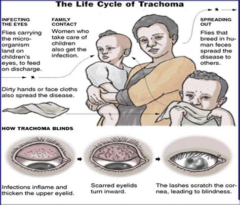 Trachoma - Causes, Symptoms, Treatment, Diagnosis and Prevention ...