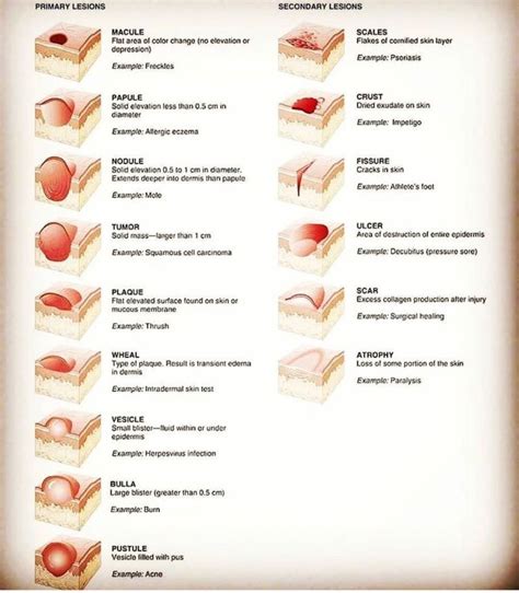 Macule Vs Papule