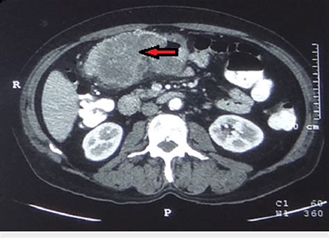 Preoperative CECT abdomen showing enhancing heterogenous transverse ...