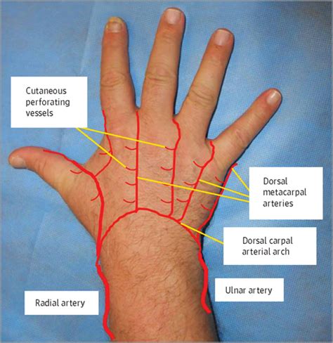 Local Fasciocutaneous Sliding Flaps for Soft-Tissue Defects of the ...