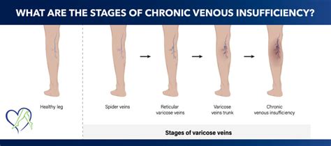 What Are the Stages of Chronic Venous Insufficiency?