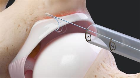 Arthrex - Revision Acetabular Labral Repair Using the Knotless Hip ...