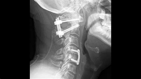 Posterior Occipital C1 And C2 Fusion Part 1 Occipital Neck Surgery ...