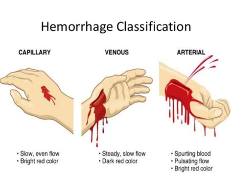 Controlling External Bleeding