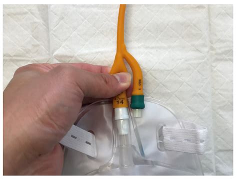 Do It Yourself: How to Unclog a Blocked Foley Catheter