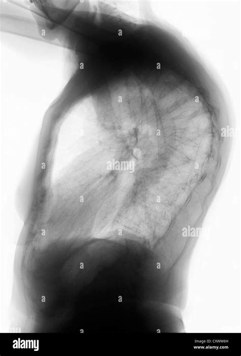 Osteoporosis Bone Scan Stock Photos & Osteoporosis Bone Scan Stock ...