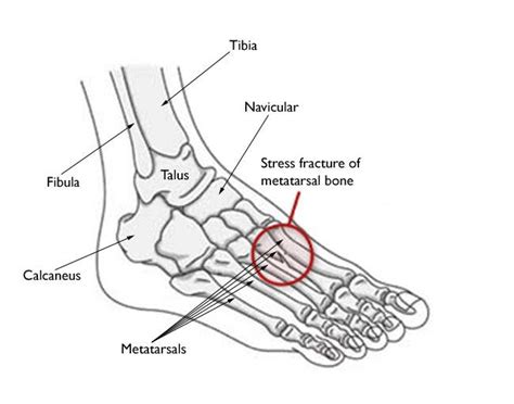 Metatarsal Stress Fracture