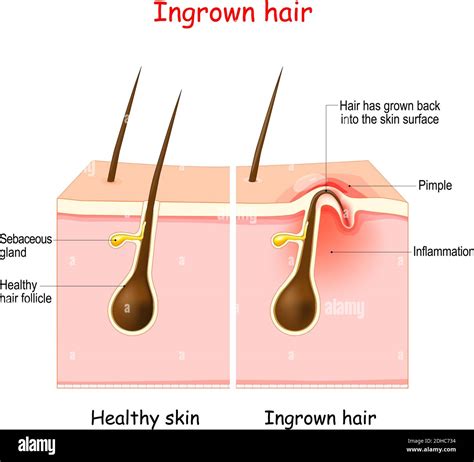 Ingrown Hair Removal