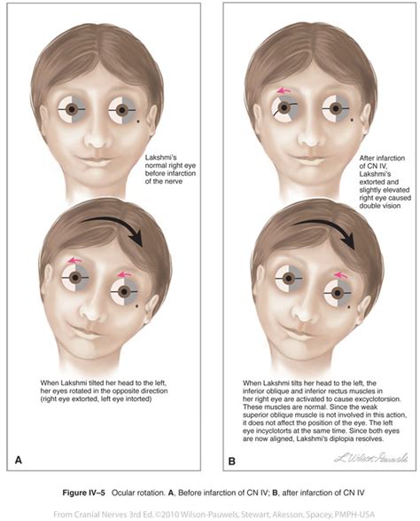 Cranial Nerves 3rd Edition: Trochlear IV