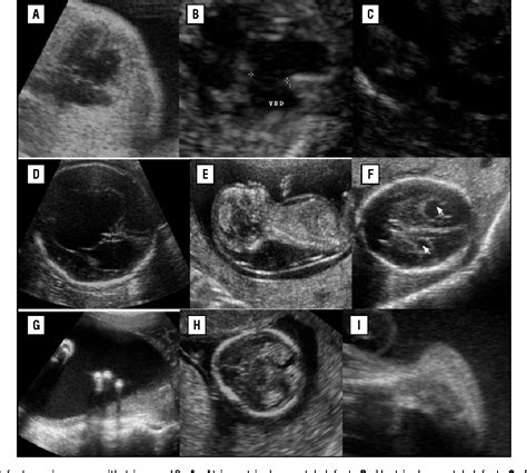 [PDF] Ultrasound in Trisomy 18 and 13 | Semantic Scholar