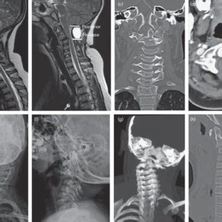 (PDF) Craniocervical spinal instability after type 1 Arnold Chiari ...