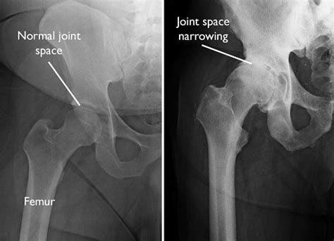 Hip Osteoarthritis - OrthoInfo - AAOS