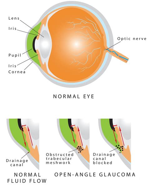 Types of Glaucoma - Glaucoma Associates of Texas