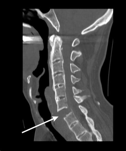 Cervical Spine Fracture in Ankylosing Spondylitis - The Western Journal ...