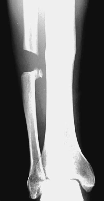 Fractured Fibula X Ray