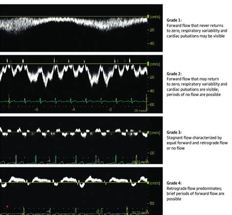 Internal Jugular Vein Blood Flow Velocity Waveform Grading Scale ...