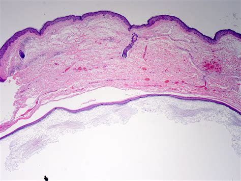 Pedicab Énfasis crisantemo pilar cyst histology índice novato Condición